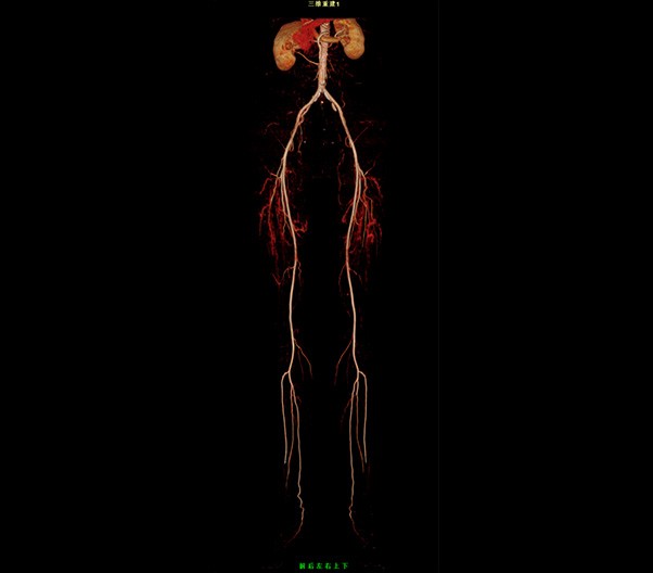 Lower Limbs CTA